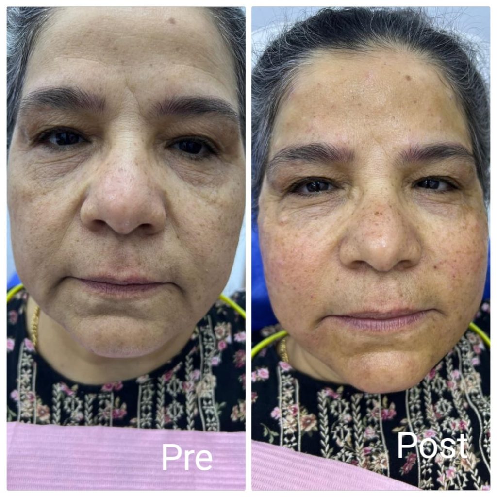 تسمين الخدود